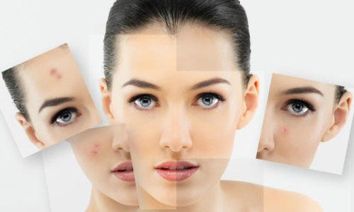Top 5 kem trị mụn hiệu quả nhất hiện nay cho các bạn nữ