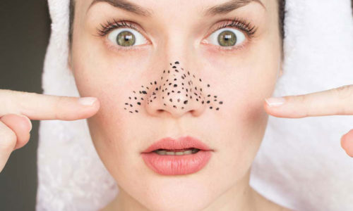 Những cách làm sạch mụn đầu đen bằng kem đánh răng cho làn da đẹp