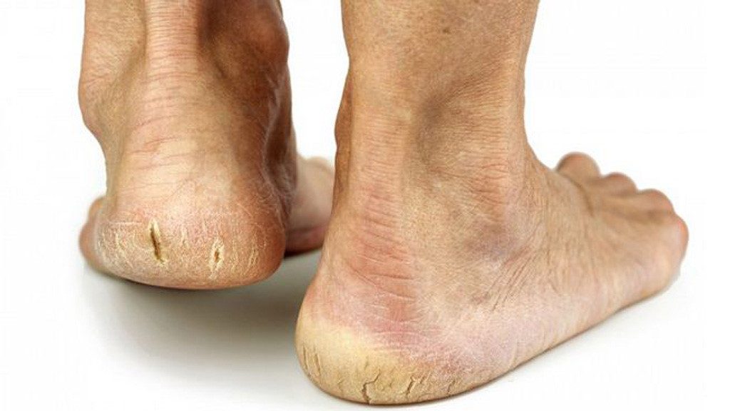 Nguyên nhân dẫn đến tình trạng nứt gót chân Nguyên nhân dẫn đến tình trạng nứt gót chân