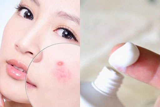 Một số lưu ý khi áp dụng cách làm sạch mụn đầu đen bằng kem đánh răng. Một số lưu ý khi áp dụng cách làm sạch mụn đầu đen bằng kem đánh răng.