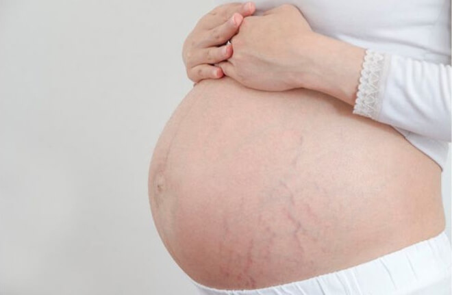 Những ai nên sử dụng kem trị rạn da Những ai nên sử dụng kem trị rạn da