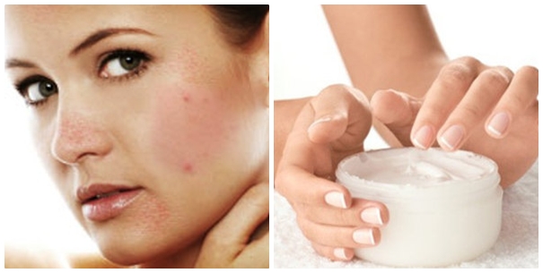 Có nên sử dụng kem trị thâm mụn Có nên sử dụng kem trị thâm mụn