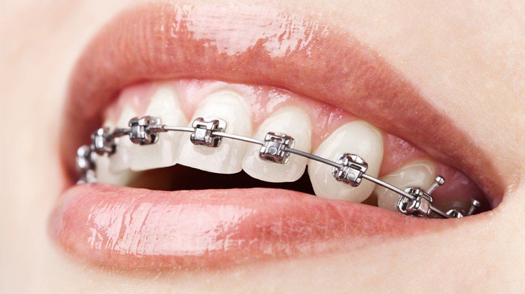  Niềng răng mắc cài tự động là gì? 