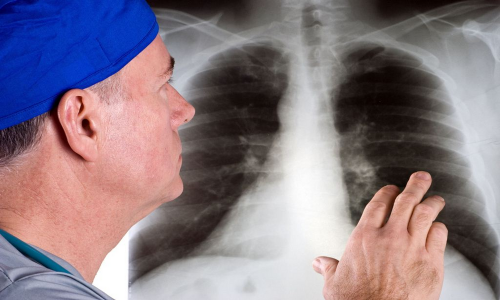Bệnh bụi phổi - Nguyên nhân và những cách phòng tránh